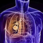 Keytruda, il farmaco che sconfigge il cancro ai polmoni… e la chemio