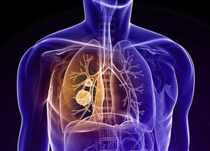 Keytruda, il farmaco che sconfigge il cancro ai polmoni… e la chemio
